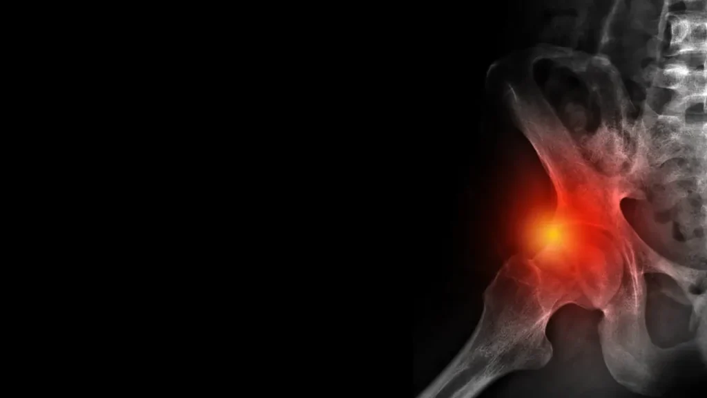 תסמונת צביטה בירך